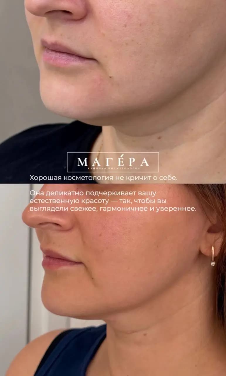 Результат SMAS-лифтинга овала лица в профиль: до и после